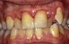 歯周病の場合の写真2