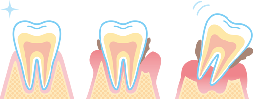 歯周病の経過