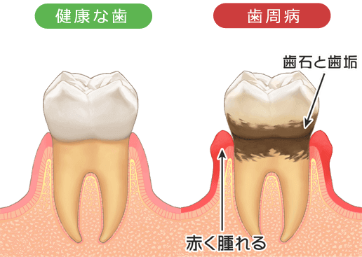 歯ぐきが腫れた原因や治療法 吹田市の歯医者 まつもと歯科