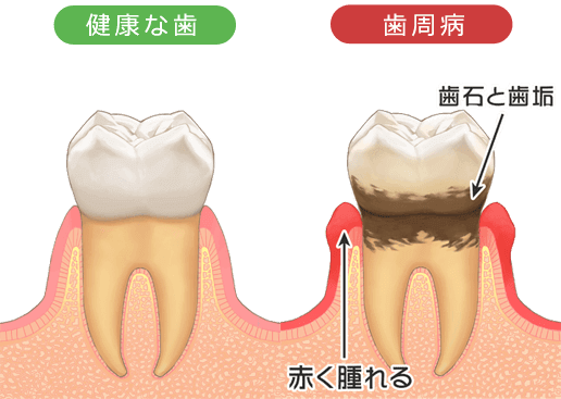 健康な歯と歯周病