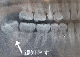 親知らず