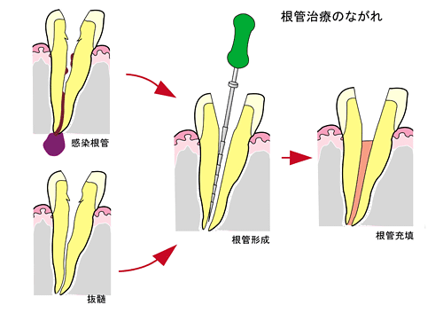 根管治療の流れ