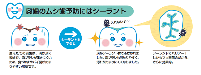 シーラント