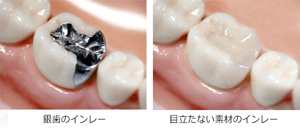 銀歯のインレーと目立たない素材のインレー