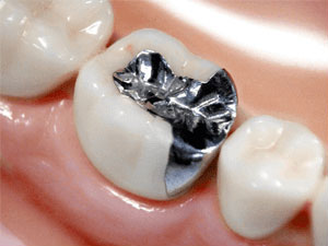 銀歯のインレー
