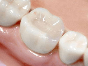 目立たないインレー