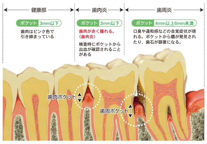 歯肉炎、歯周病の説明