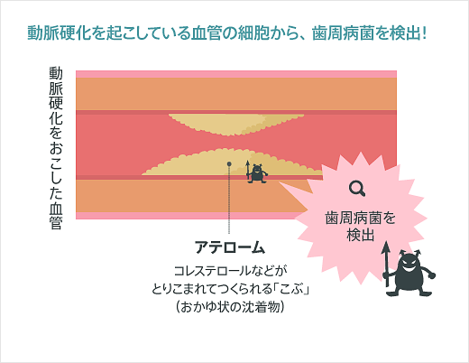 動脈硬化を起こしている血管のさいぼ王から歯周病菌を検出