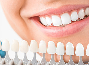 シェードガイドと白い歯の女性