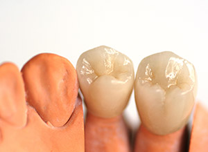 被せ物のイメージ