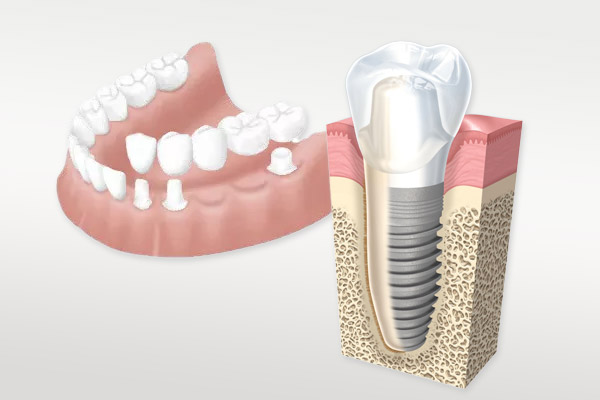 ブリッジとインプラントの比較