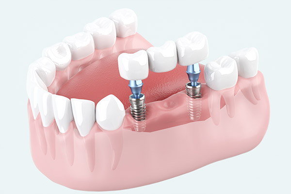 インプラント治療の流れ