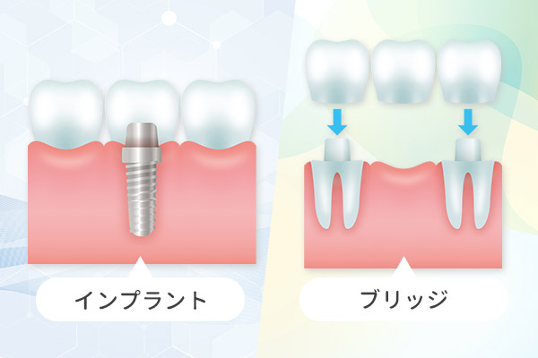 ブリッジとインプラント