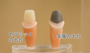 インプラントの土台