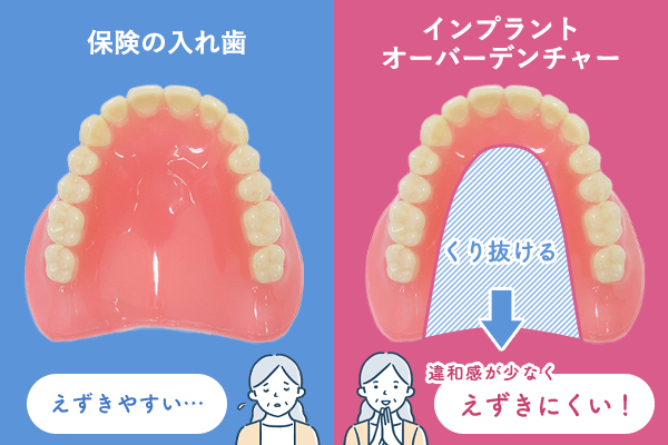 入れ歯とオーバーデンチャーの違い