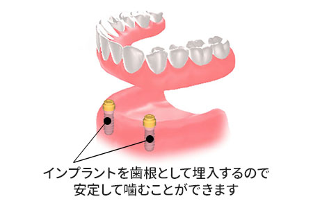 普通の入れ歯