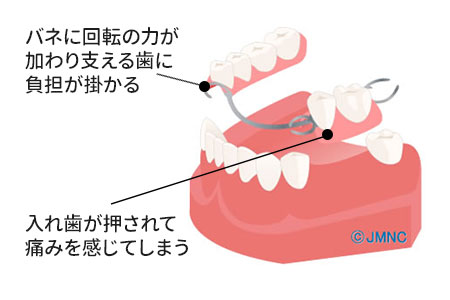 インプラントオーバーデンチャー