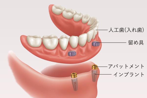 前歯のインプラント