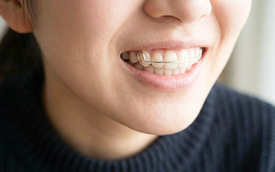 保定装置（リテーナー）を装着している様子