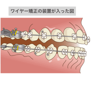 ワイヤー矯正の装置が入った図