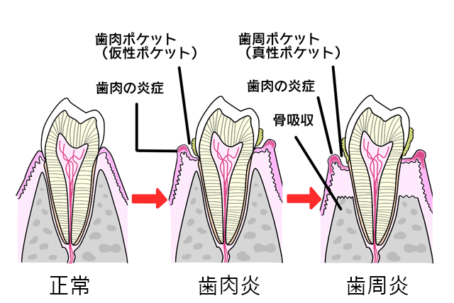 歯肉炎と歯周炎の違い