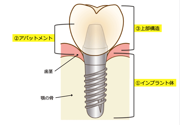 インプラントの構造