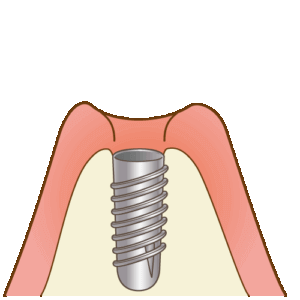 インプラント埋入直後