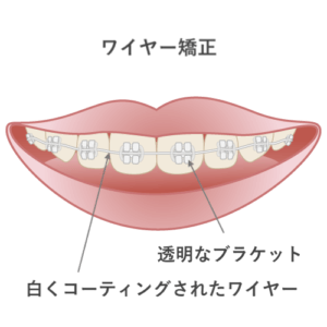 透明なブラケットと白くコーティングされたワイヤー