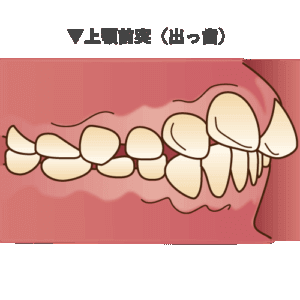 上顎前突（出っ歯）