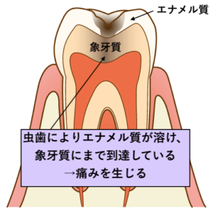 エナメル質が溶けて痛みを生じる虫歯