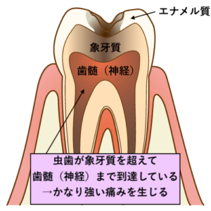 虫歯が歯髄に達して強い痛みが生じる
