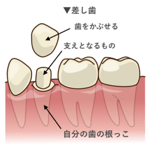 差し歯の説明図