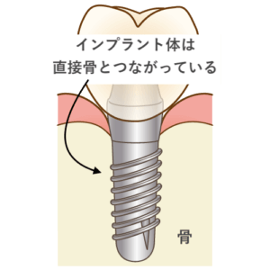 インプラントの構造