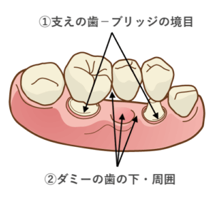 ブリッジにたまる汚れ