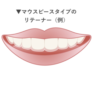 マウスピースタイプのリテーナー