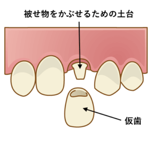 差し歯の土台と仮歯