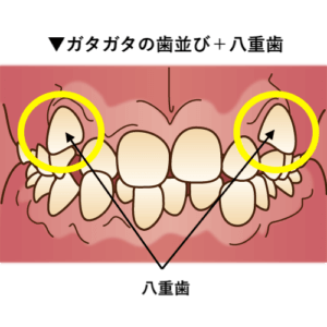 ガタガタの歯並び＋八重歯