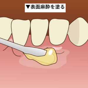 表面麻酔を塗る