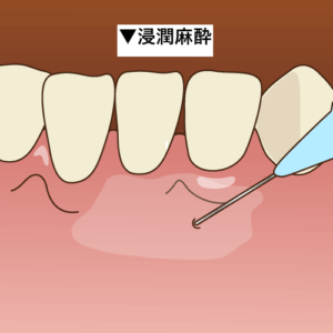 湿潤麻酔