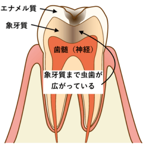 象牙質の虫歯