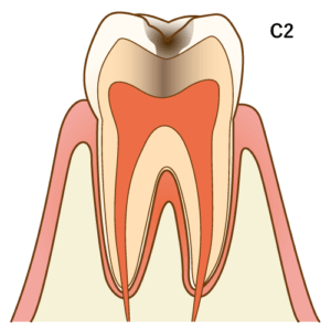 虫歯C2