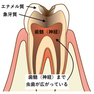 神経に達した虫歯