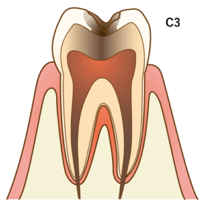 虫歯C3