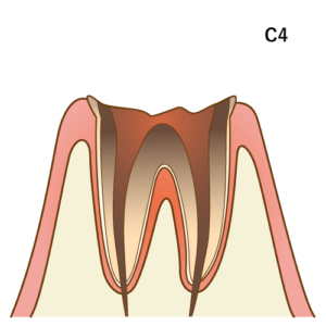 虫歯C4