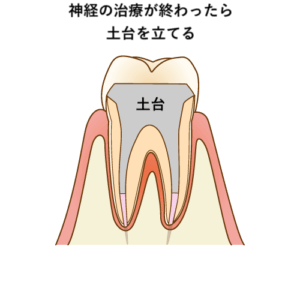 神経の治療後土台を立てる