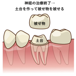 神経の治療終了後被せ物をかぶせる