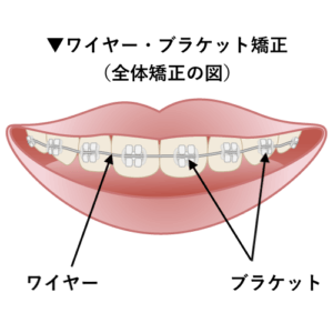 ワイヤー、ブラケットでの全体矯正