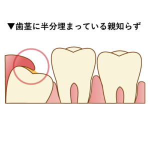 親知らずが半分埋まっている