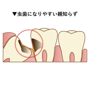 虫歯になりやすい親知らず