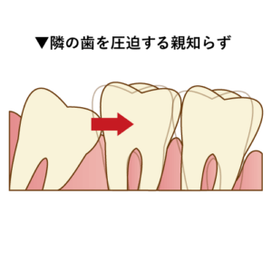 隣を歯を圧迫する親知らず